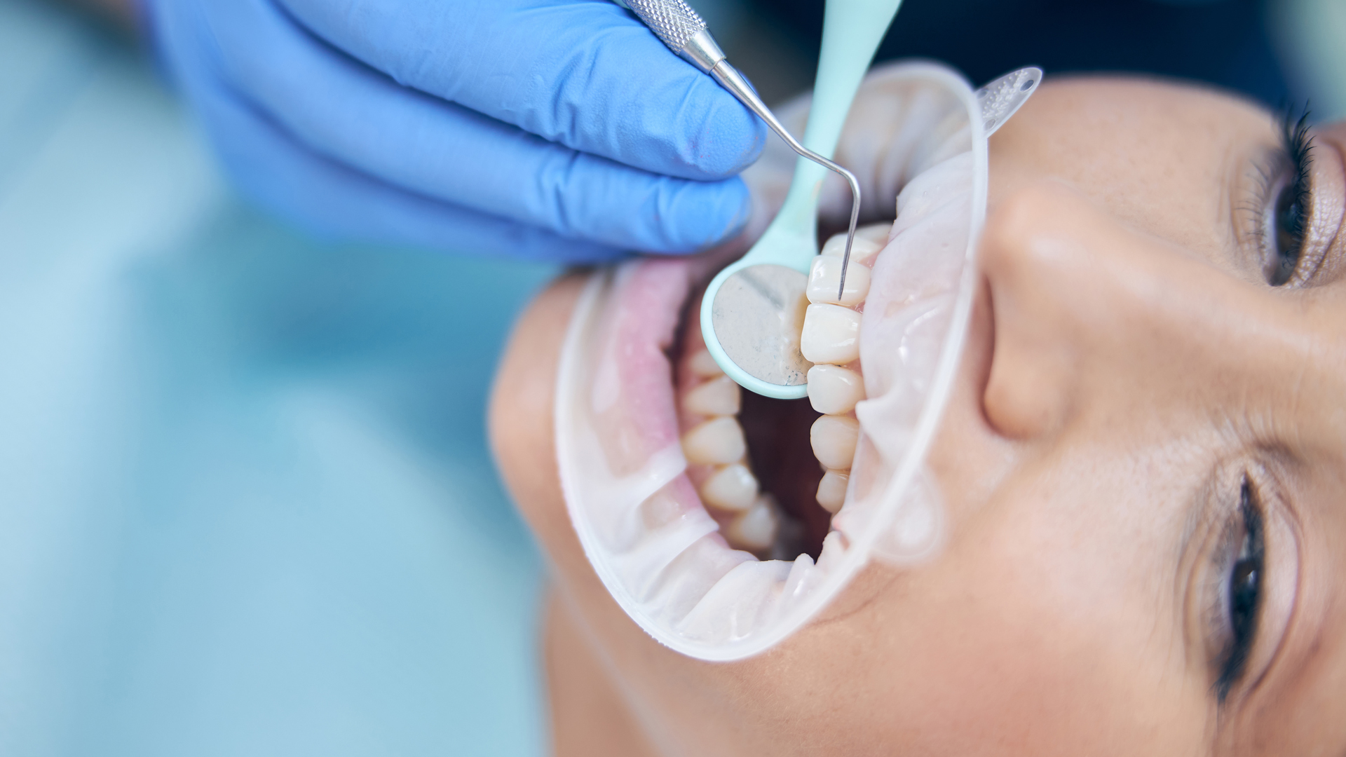 Dental Bonding, Composite Bonding, and Edge Bonding Explained