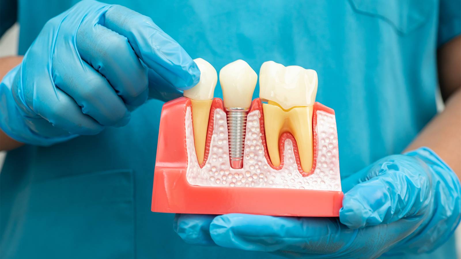 All on 4 implant treatment with fixed premium titanium based zirconia denture (per jaw)