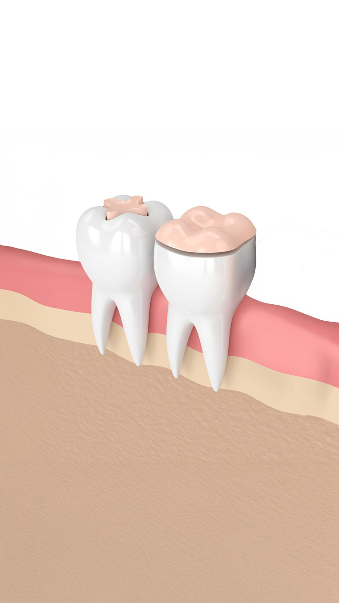 Conservative Solutions for Tooth Repair: Inlays and Onlays